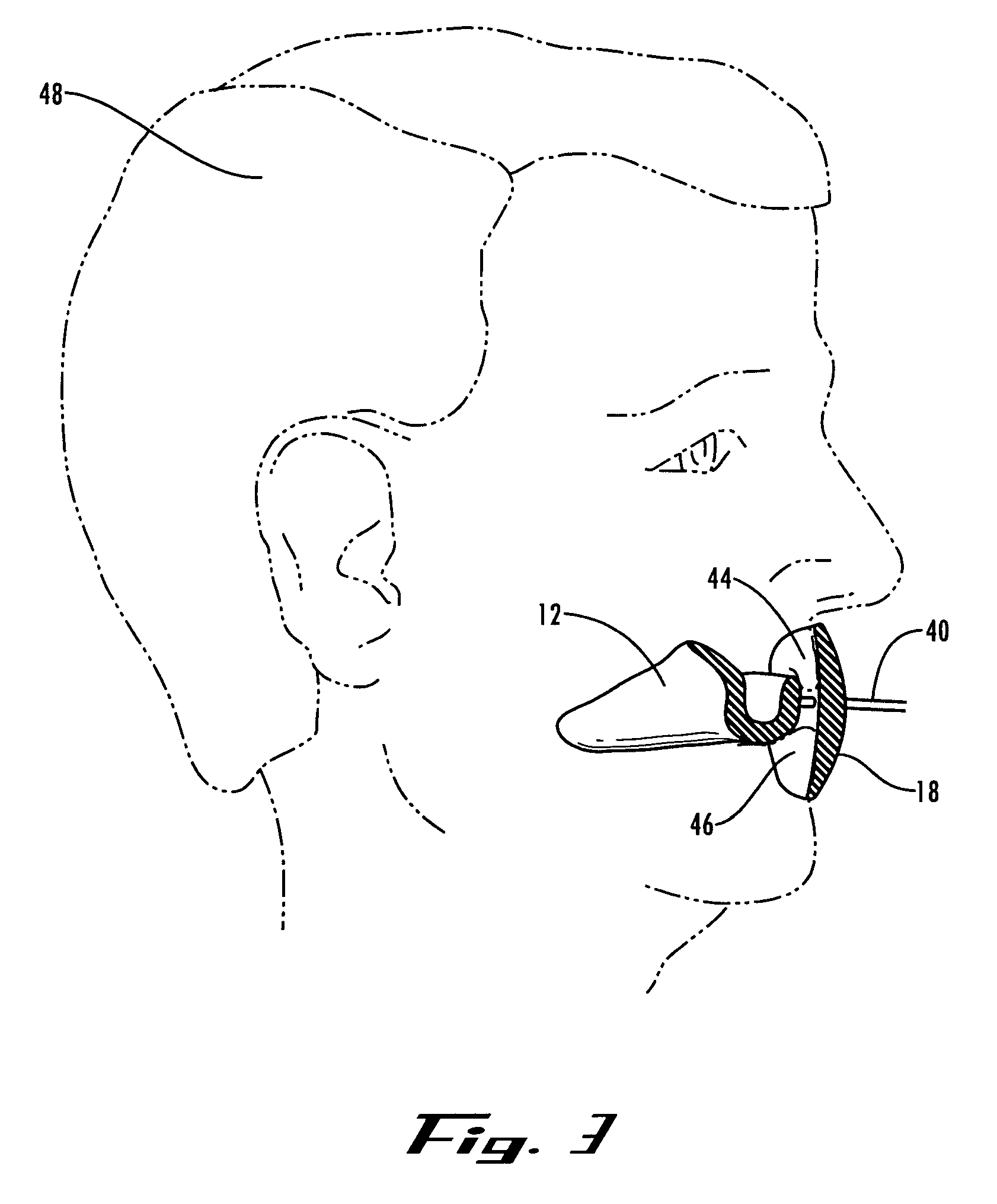 Assisted breathing device and method of wearing same