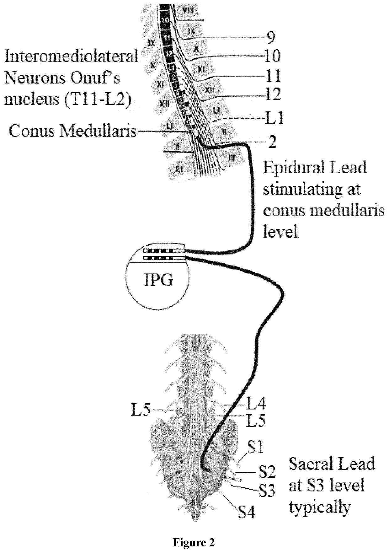 Method for treating overactive bladder and secondary fecal incontinence by neurostimulating two nerve sites