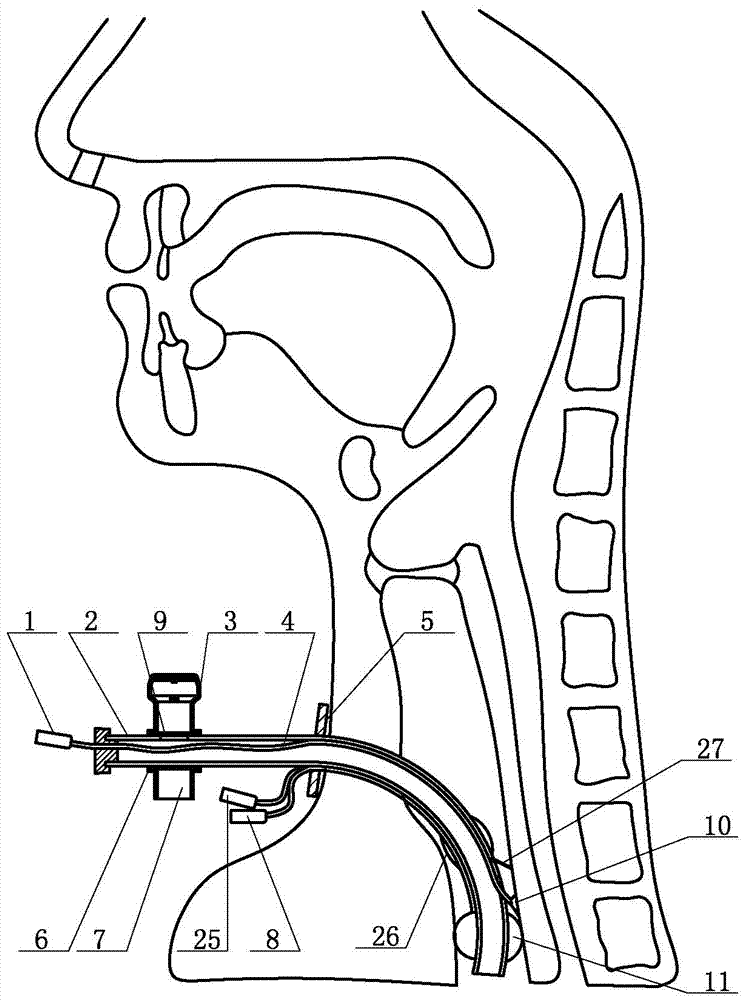 Tracheostomy tube with auxiliary sound valve function, flushable, suctionable and anti-aspiration