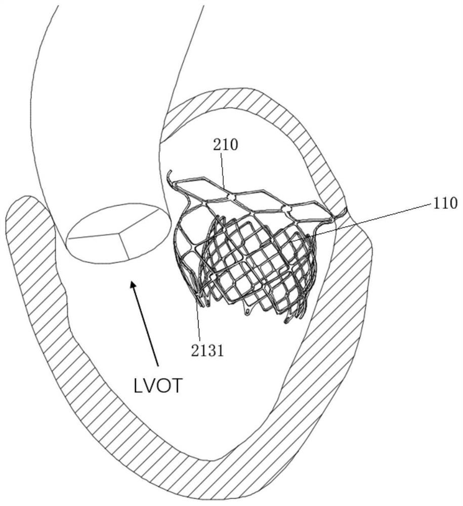 Cardiac valve prosthesis