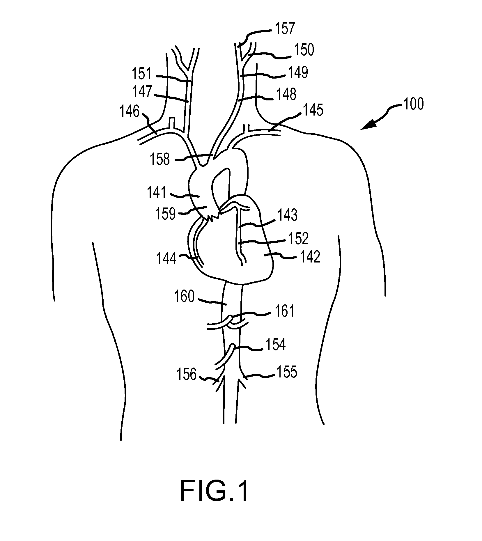 Augmented delivery catheter and method