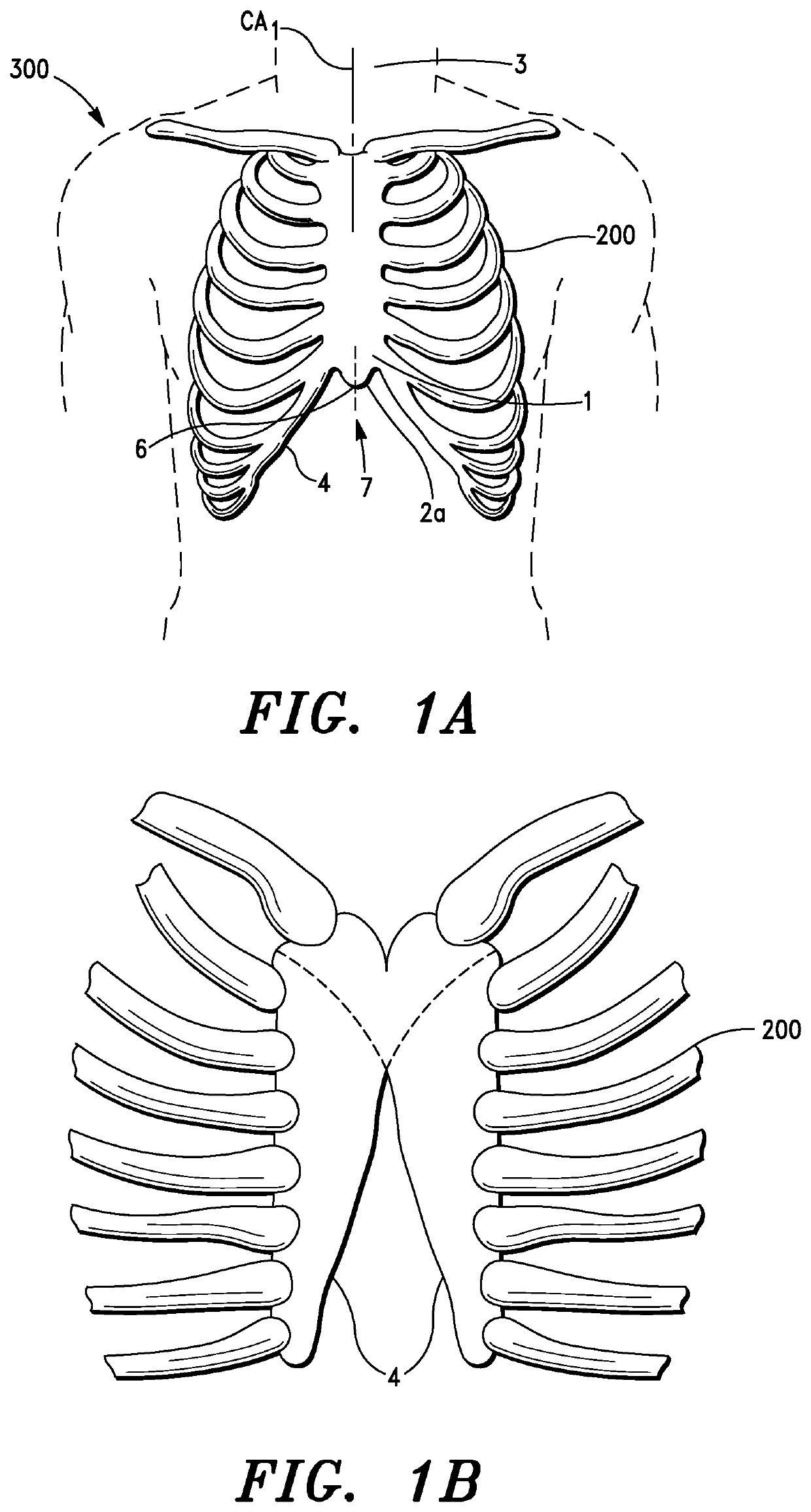 Thoracic structure access apparatus, systems and methods