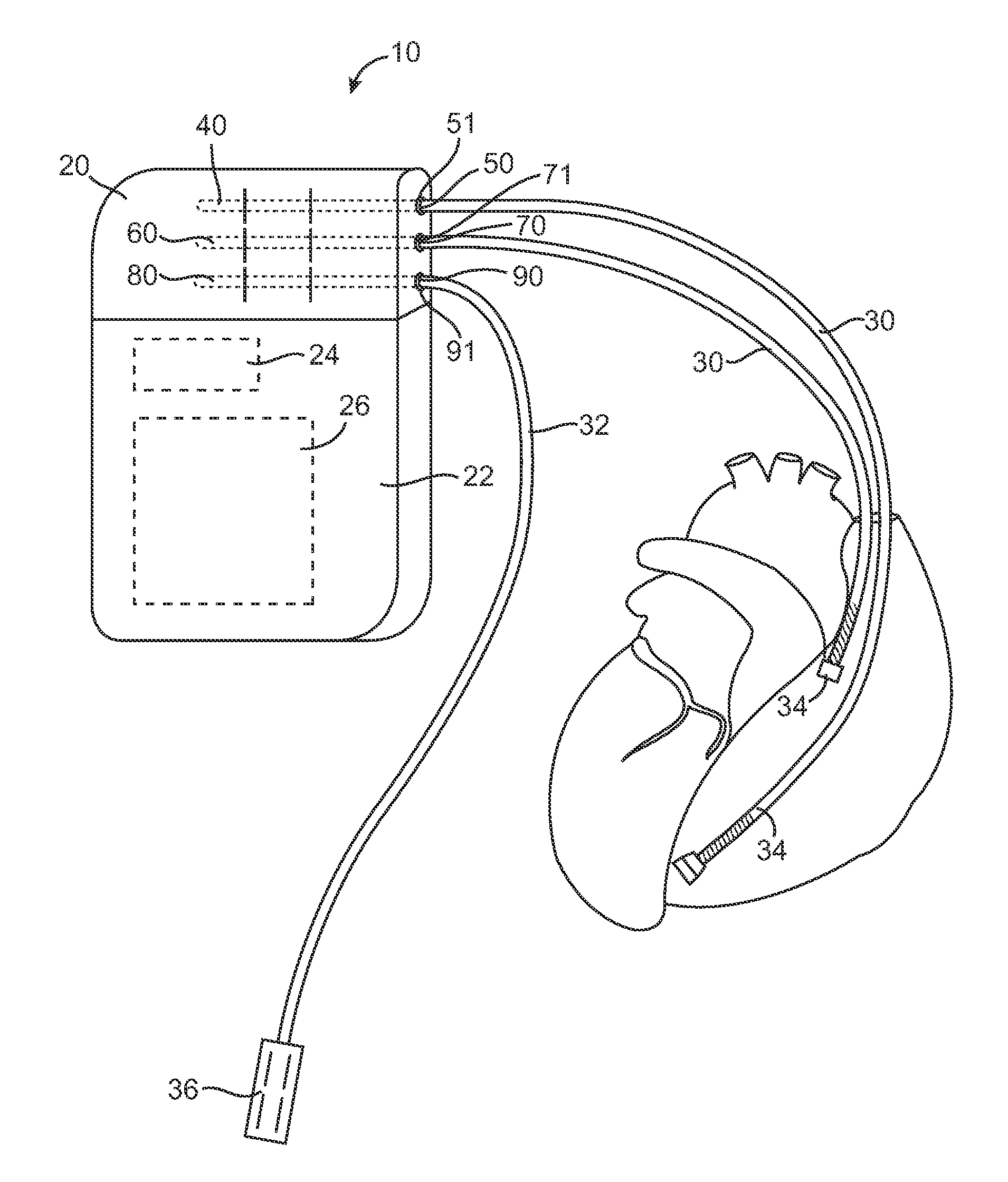 Lockout connector arrangement for implantable medical device