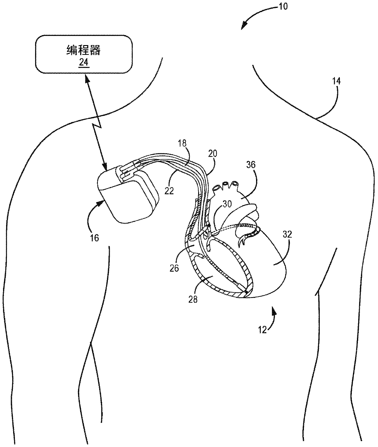 Pacemaker mediated tachycardia detection and intervention