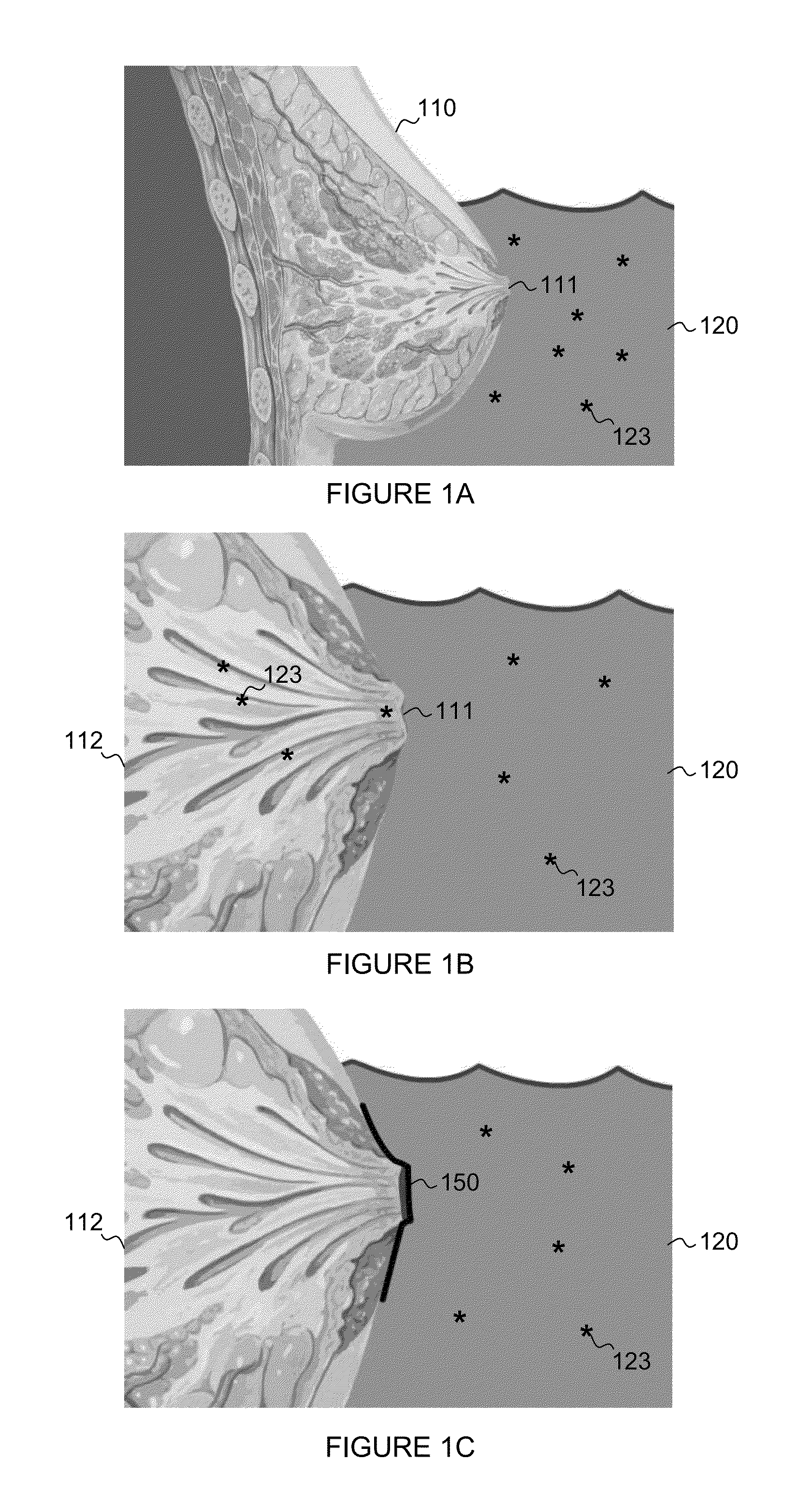 Devices, Systems and Methods to Detect and Reduce or Prevent Entry of Inflammatory Mediators into Milk Ducts