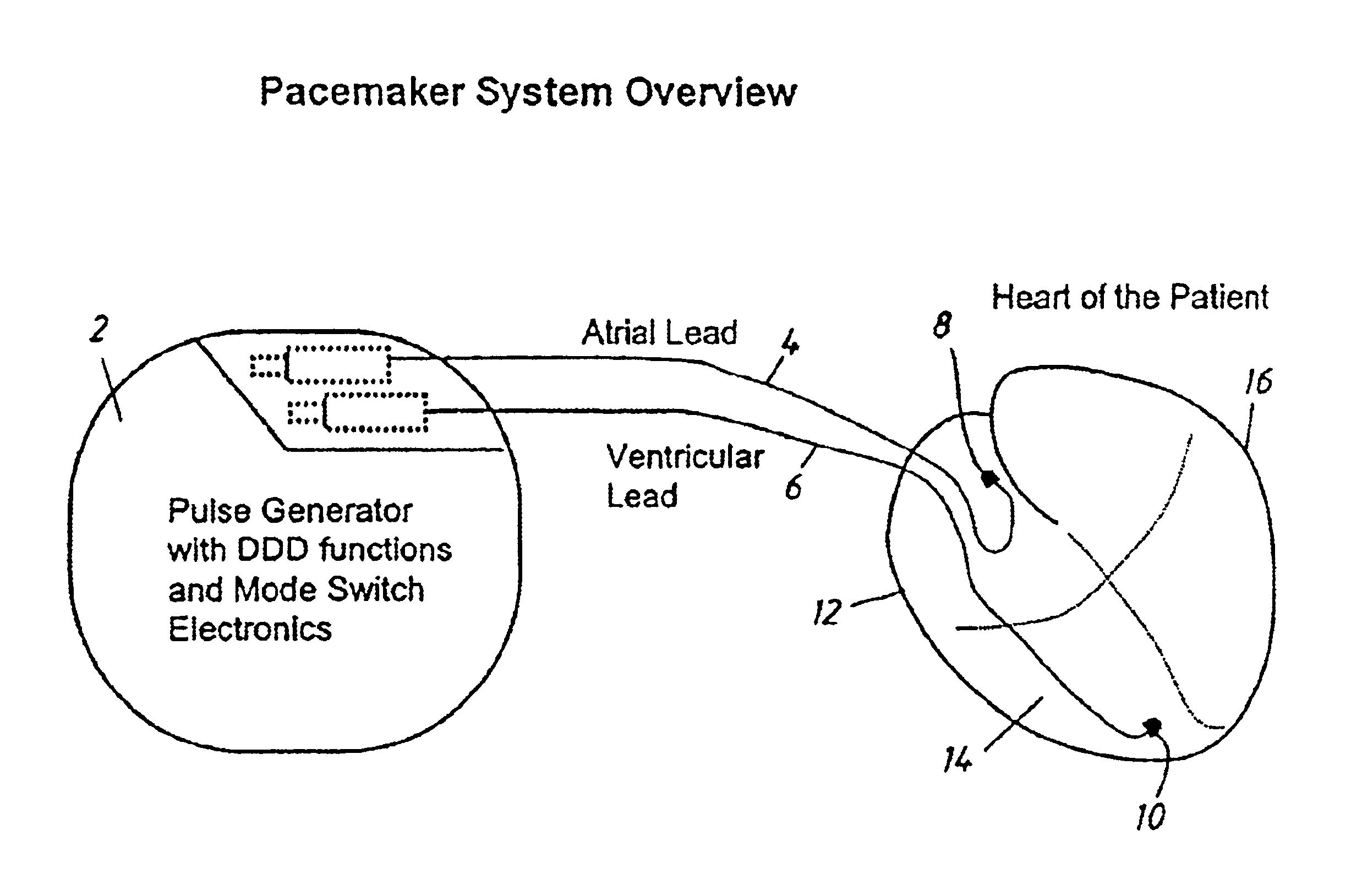 Pacemaker using measured intervals for mode switching