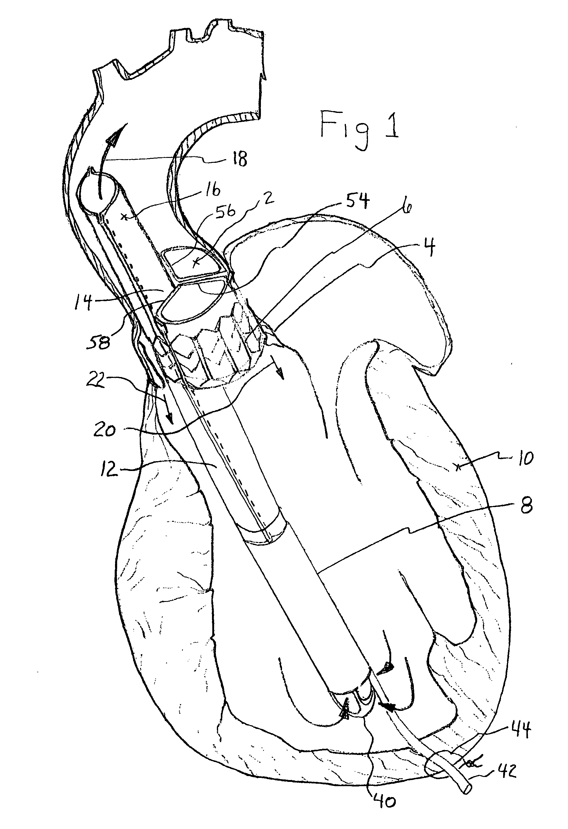 Intraventricular blood pumps anchored by expandable mounting devices