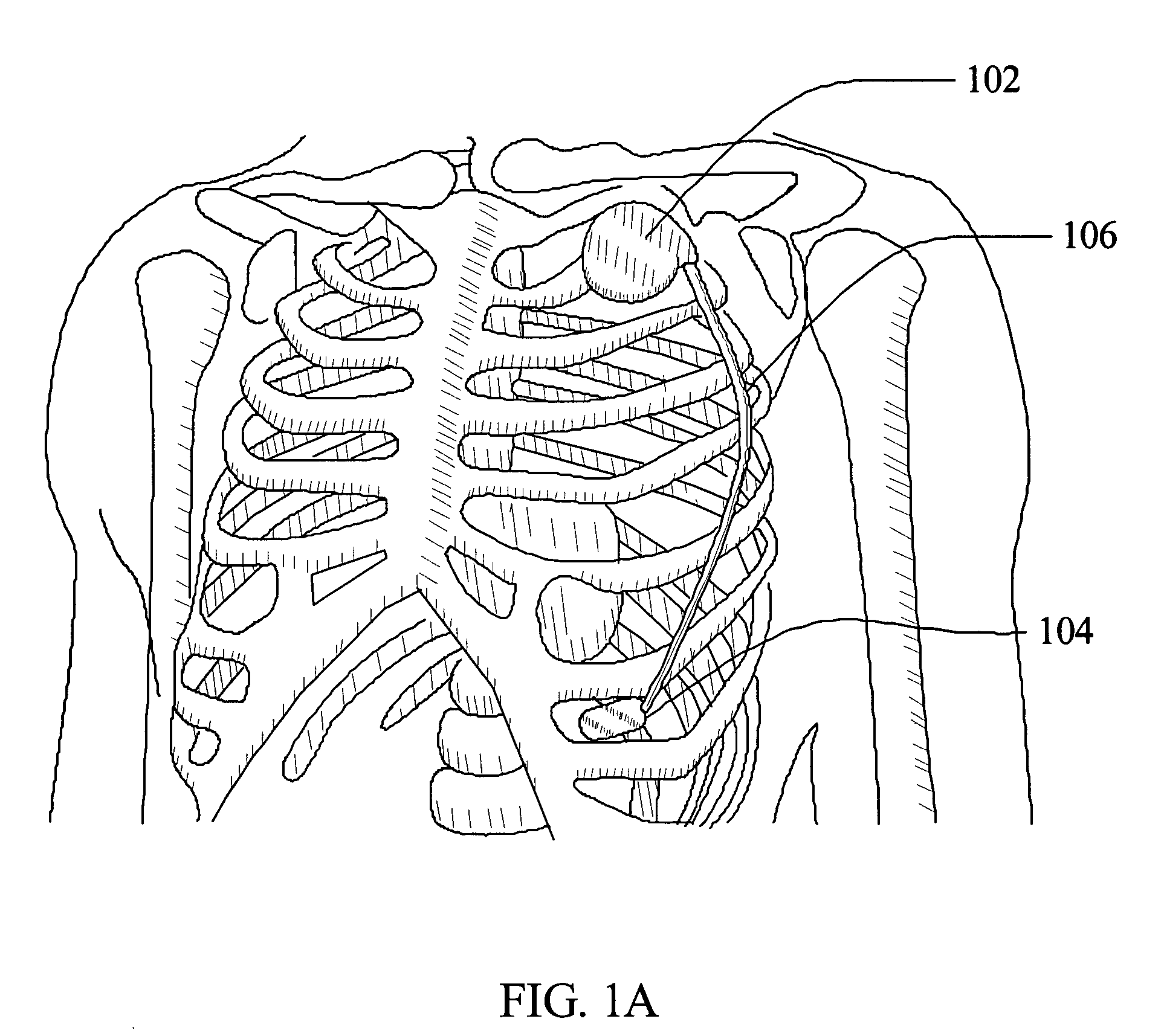 Ultrasonic subcutaneous dissection tool incorporating fluid delivery