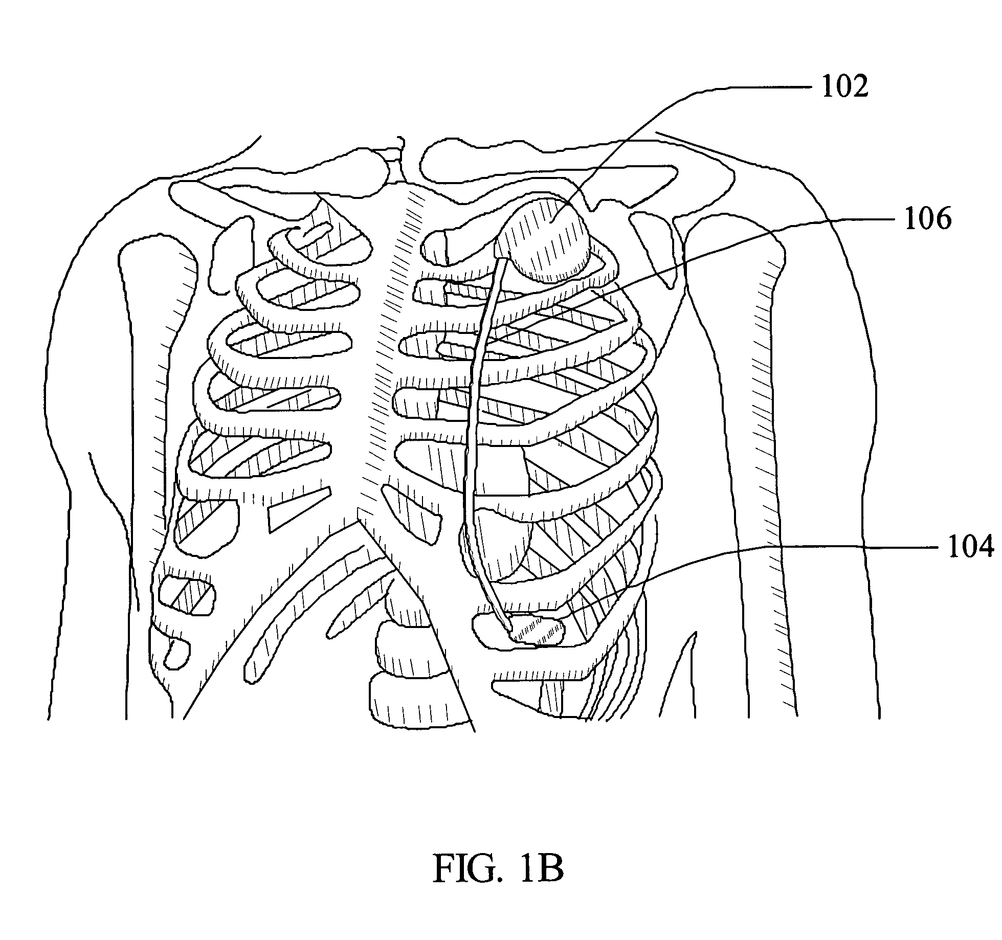 Ultrasonic subcutaneous dissection tool incorporating fluid delivery