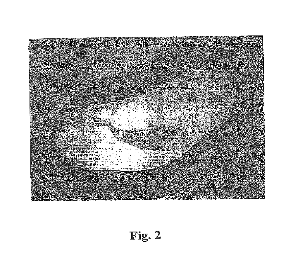 Method for improving treatment selectivity and efficacy using intravascular photodynamic therapy