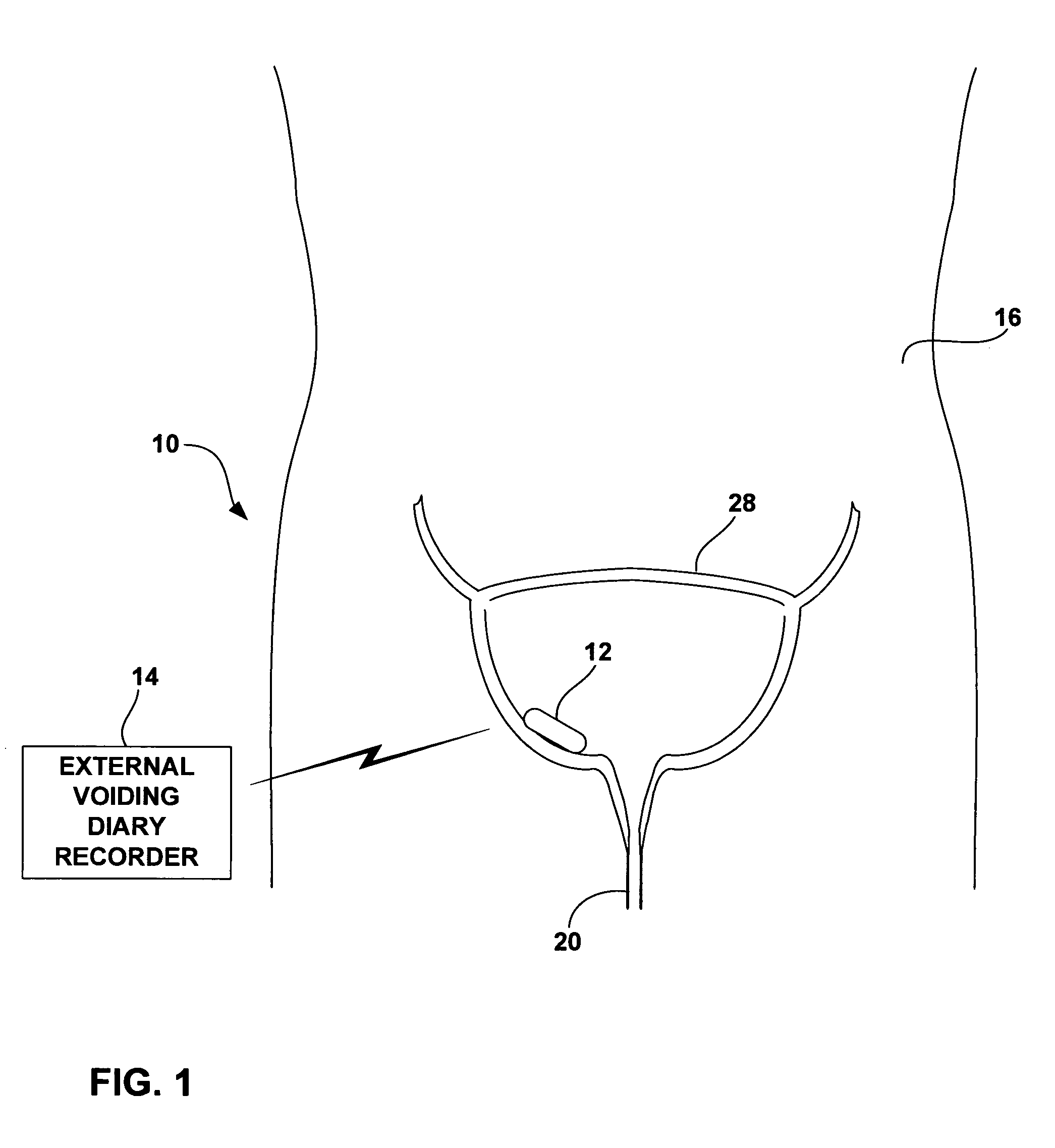 Wireless urodynamic monitoring system with automated voiding diary