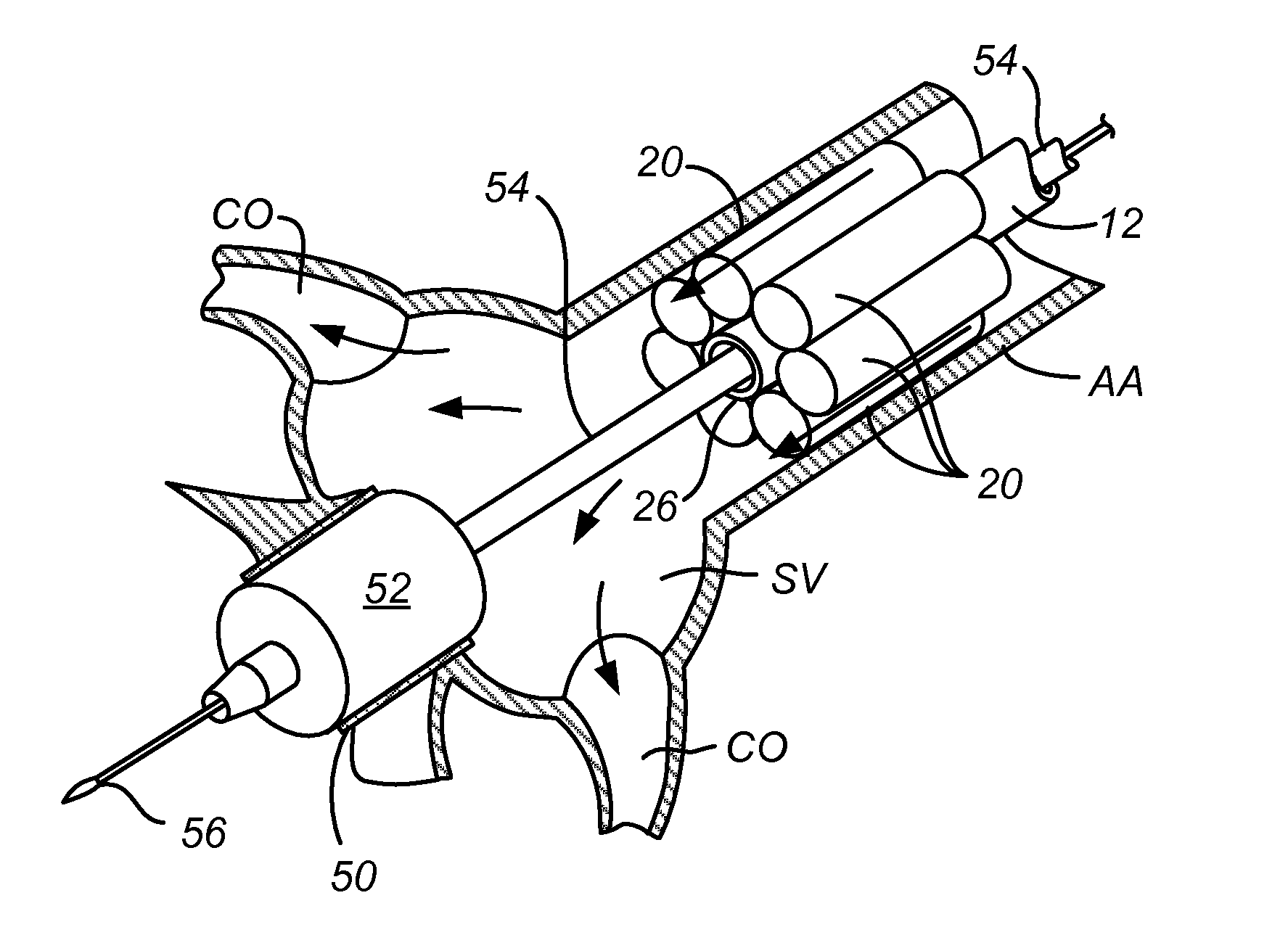 Method and system for balloon counterpulsation during aortic valve replacement