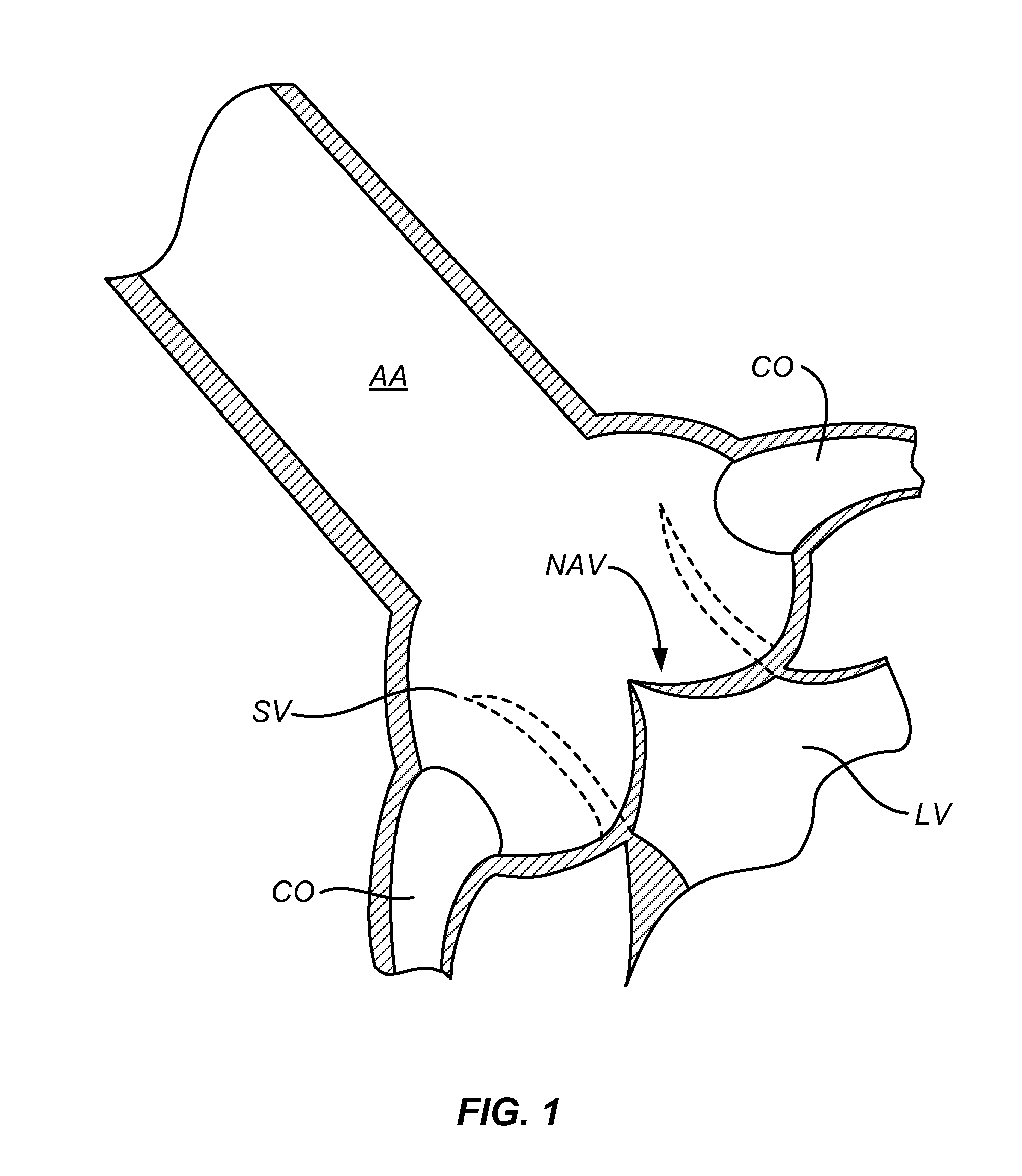 Method and system for balloon counterpulsation during aortic valve replacement