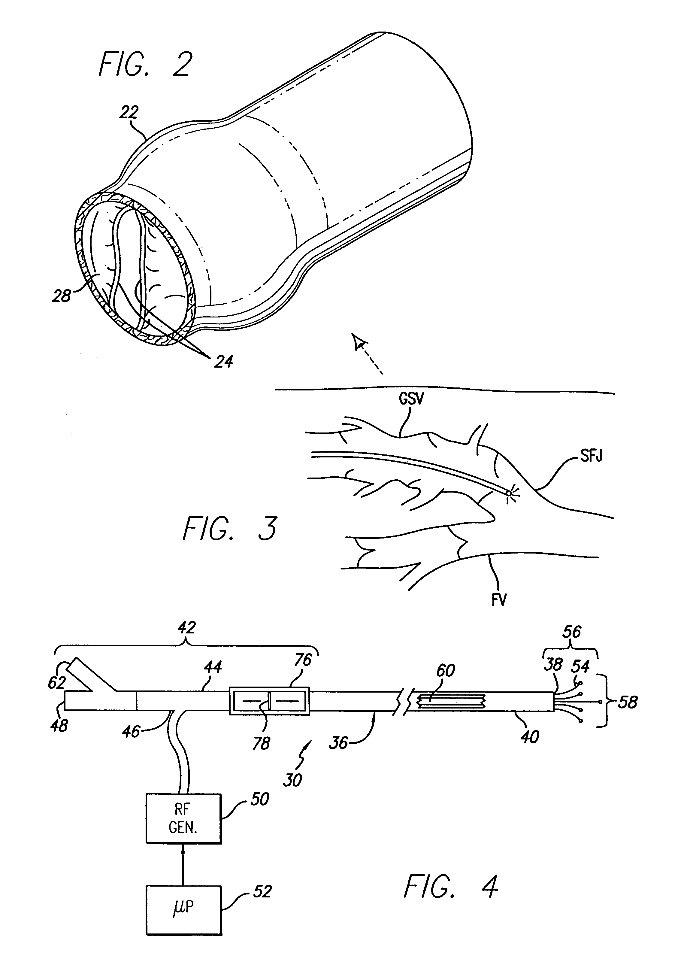 Method and apparatus for positioning a catheter relative to an anatomical junction