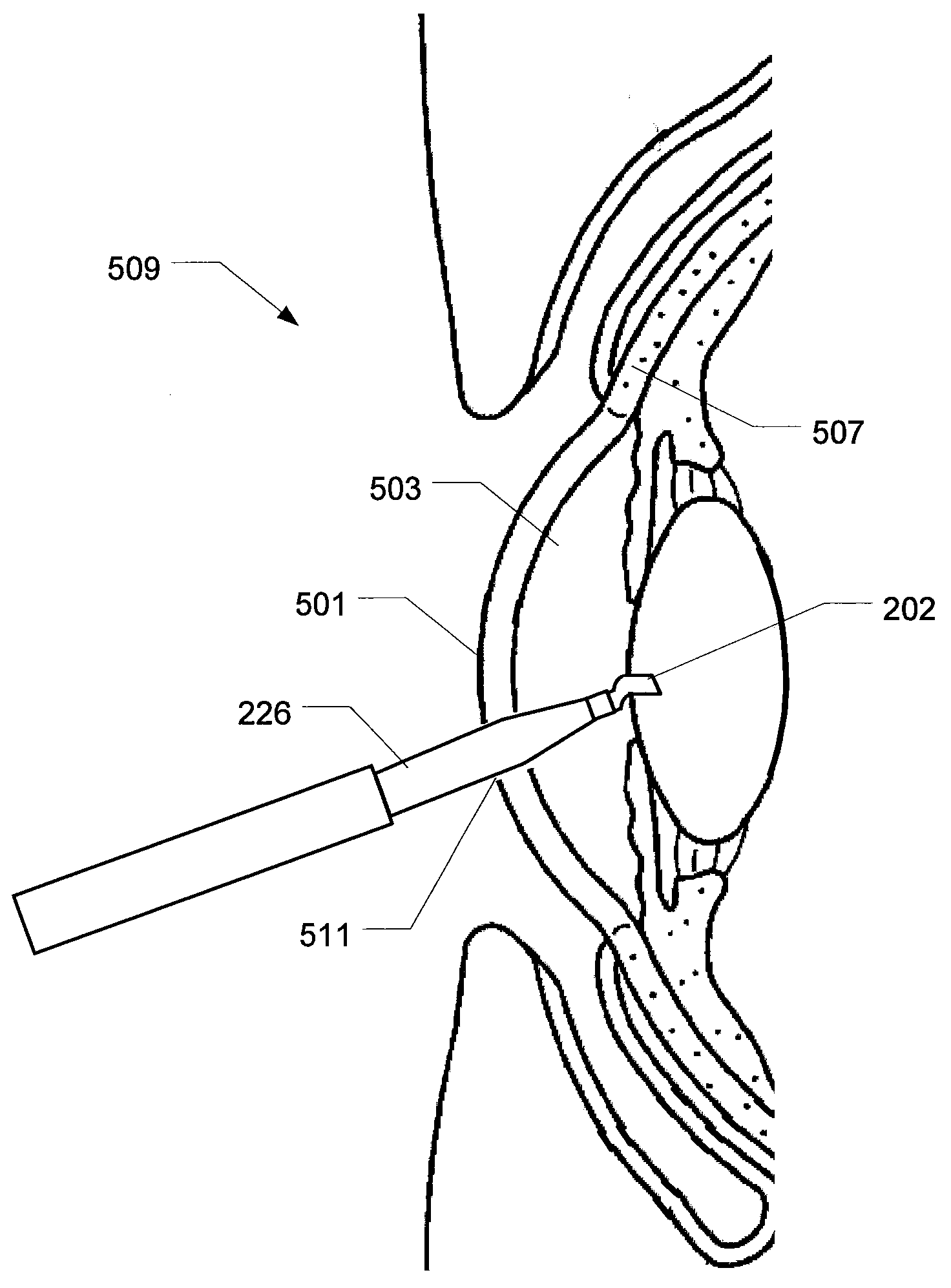 Phacoemulsification hook tip