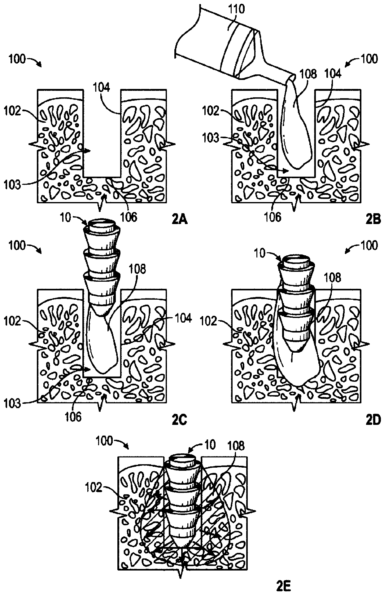 In-situ curing biodegradable anchor with reinforcement