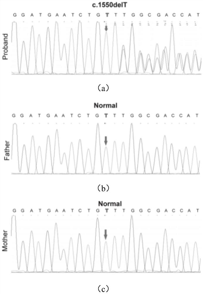 Cranial clavicle dysplasia pathogenic RUNX2 new mutation site gene, polypeptide and application