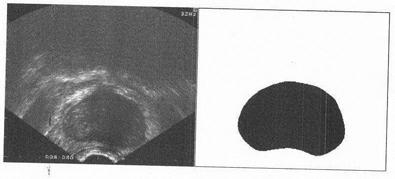 Prostate transrectal ultrasonic image segmentation method based on deep convolutional neural network