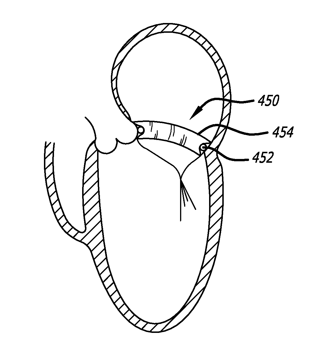 Valve replacement systems and methods