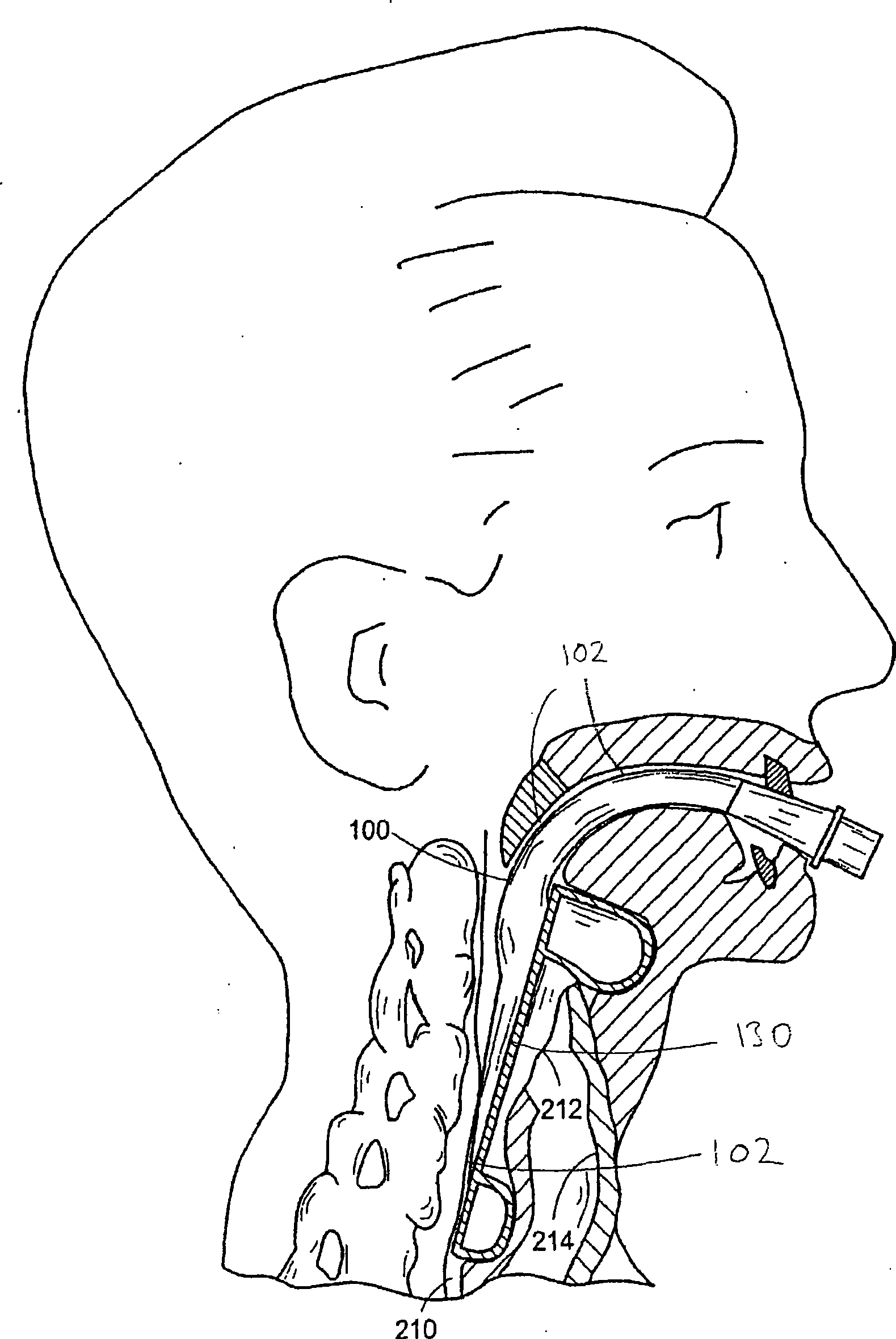 Laryngeal mask airway device including parylene