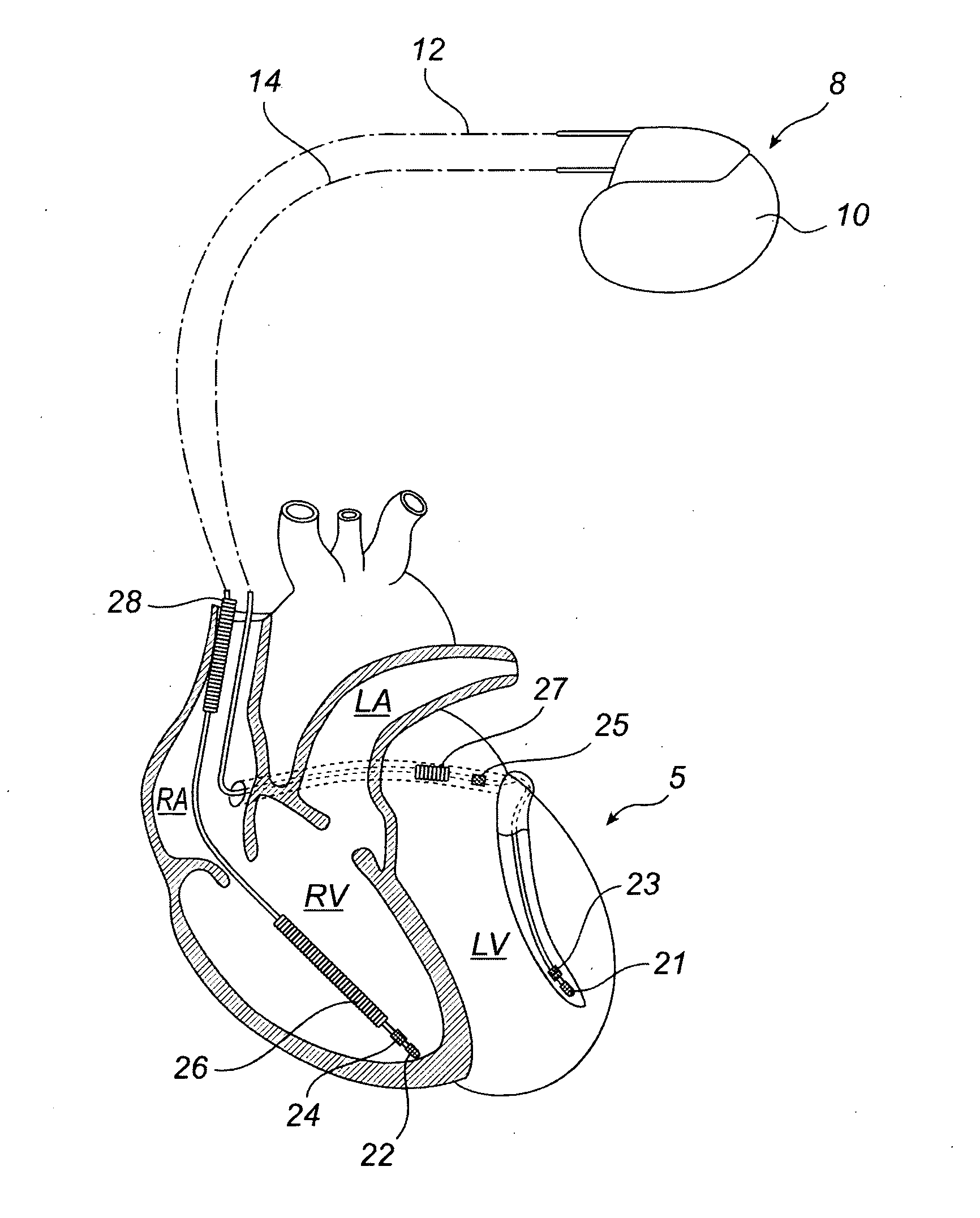 Devices and method for determining and monitoring a cardiac status of a patient by using plvdt or plvst parameters