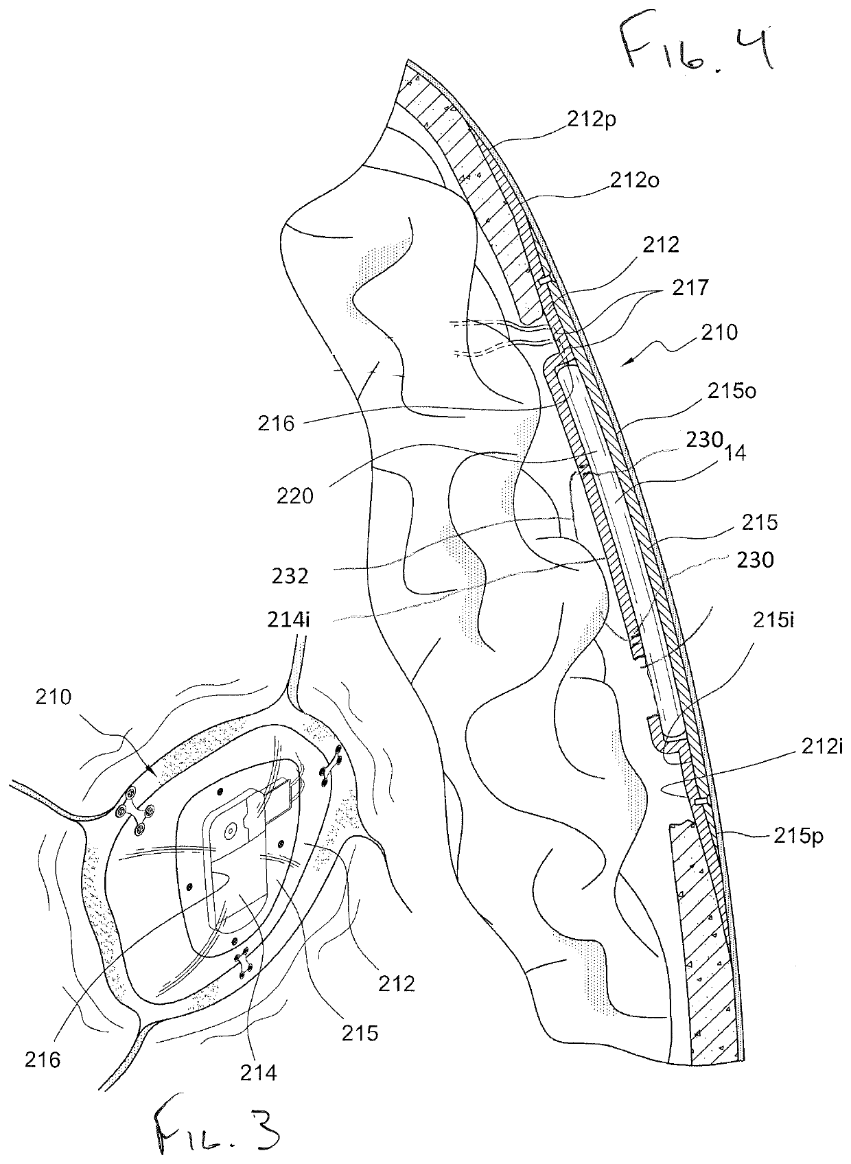 Low-profile intercranial device with enhancing grounding to ensure proper impedance measurements