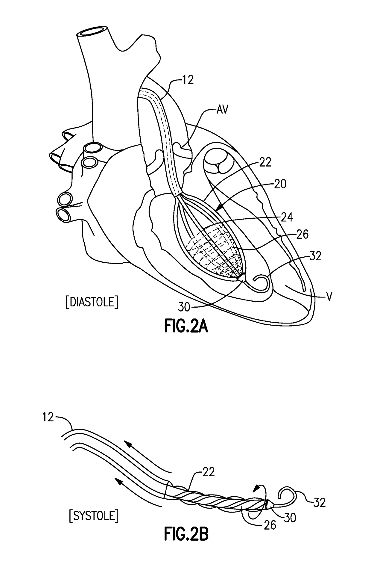 Left ventricle heart-assist device
