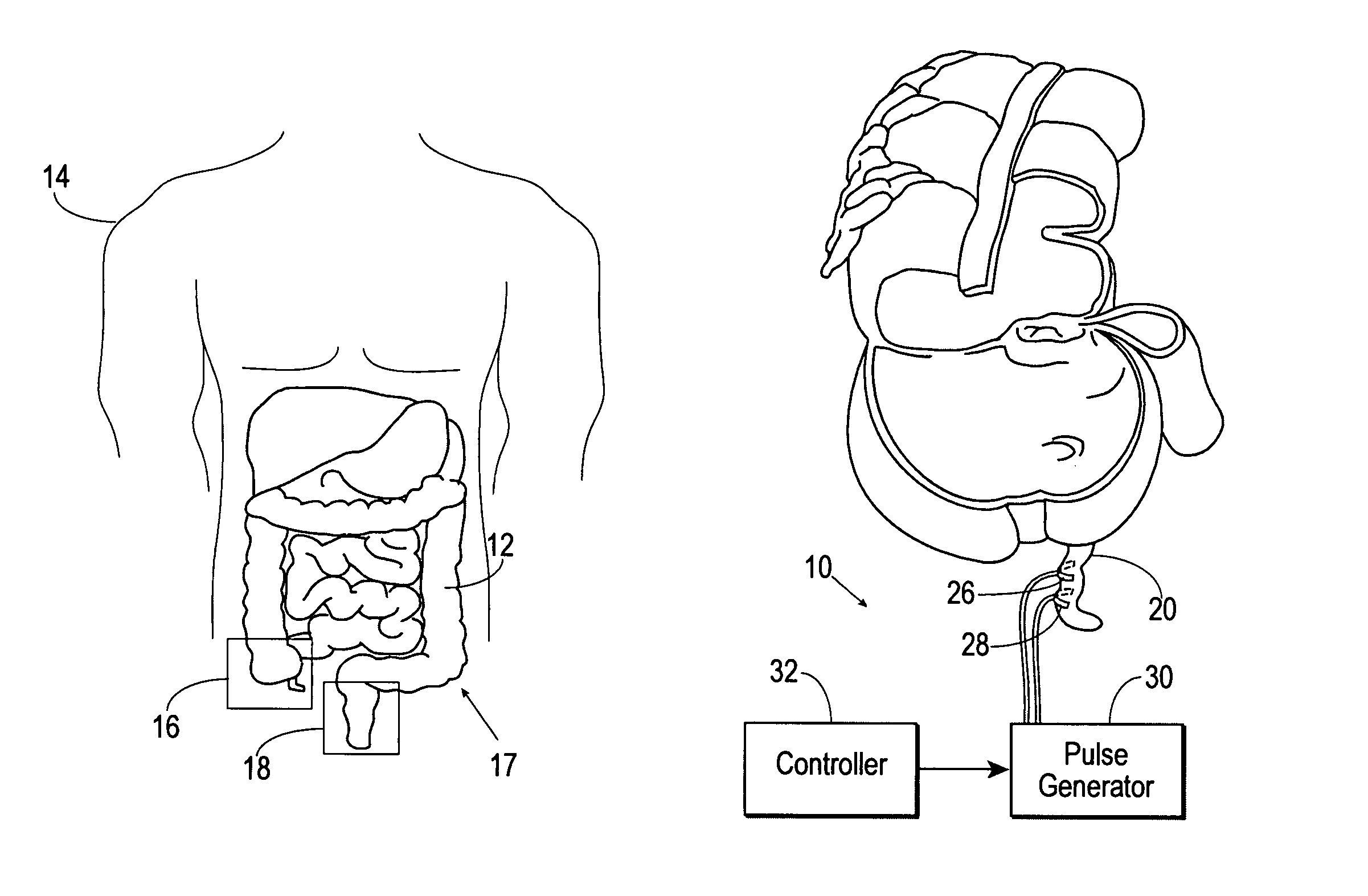 Appendicular and rectal stimulator device for digestive and eating disorders