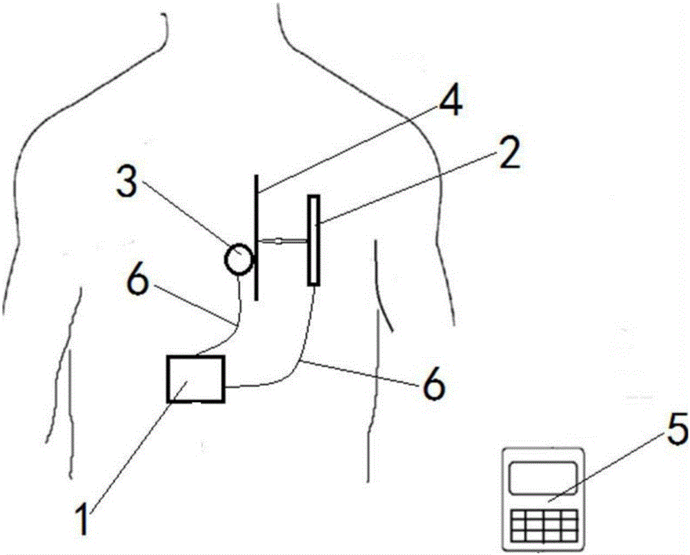 Implantable sacral nerve stimulator provided with electric-field intensity measurement device