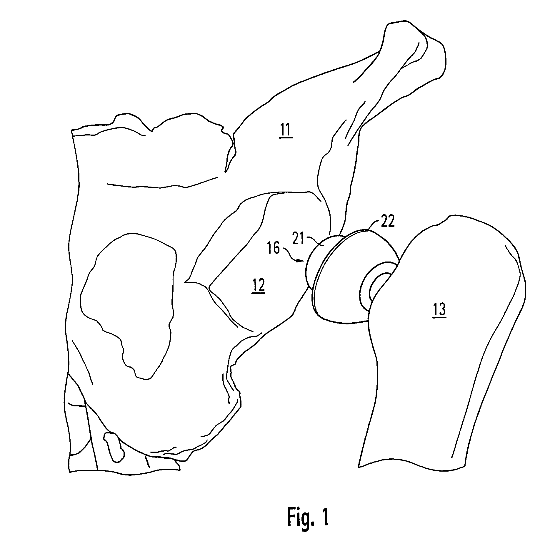 Accessory for implanting a hip endoprosthesis, and method for manipulating the same