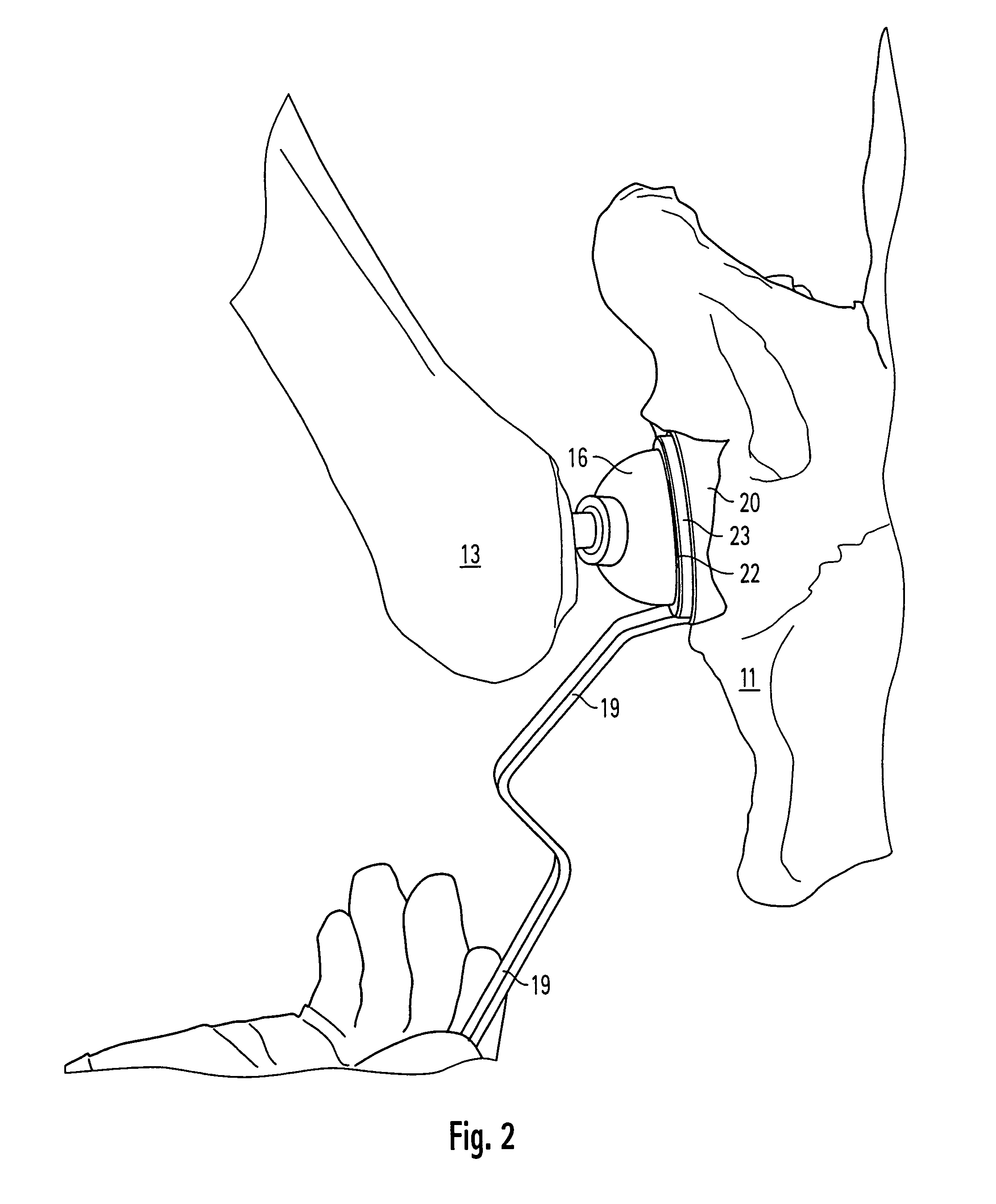 Accessory for implanting a hip endoprosthesis, and method for manipulating the same
