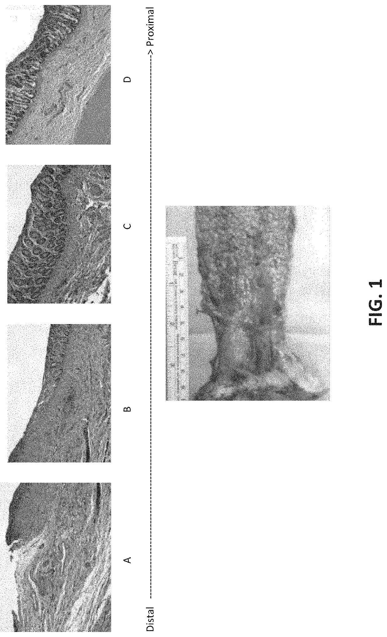 Method and composition for treating inflammatory bowel disease