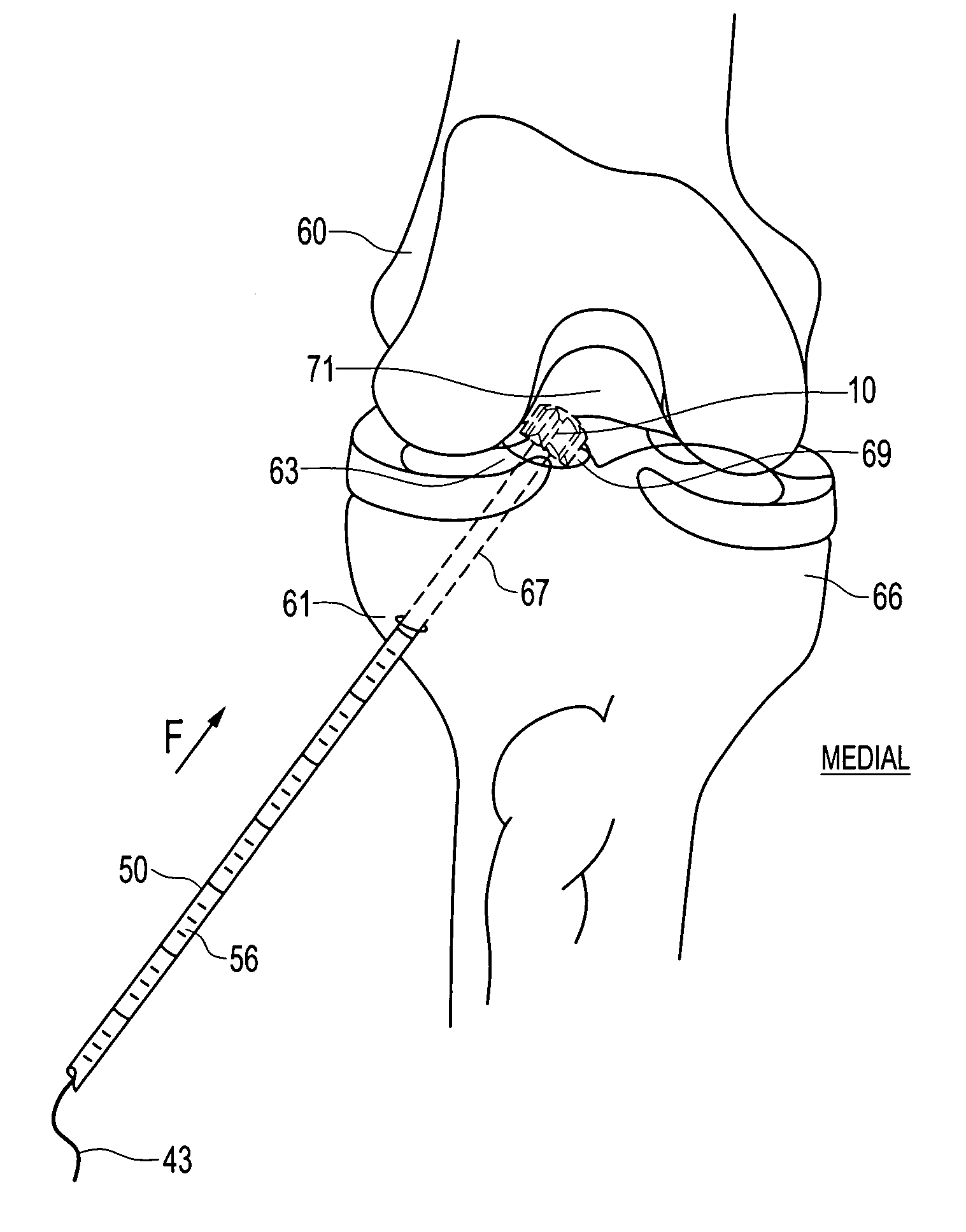 Retrodrill technique for insertion of autograft, allograft or synthetic osteochondral implants