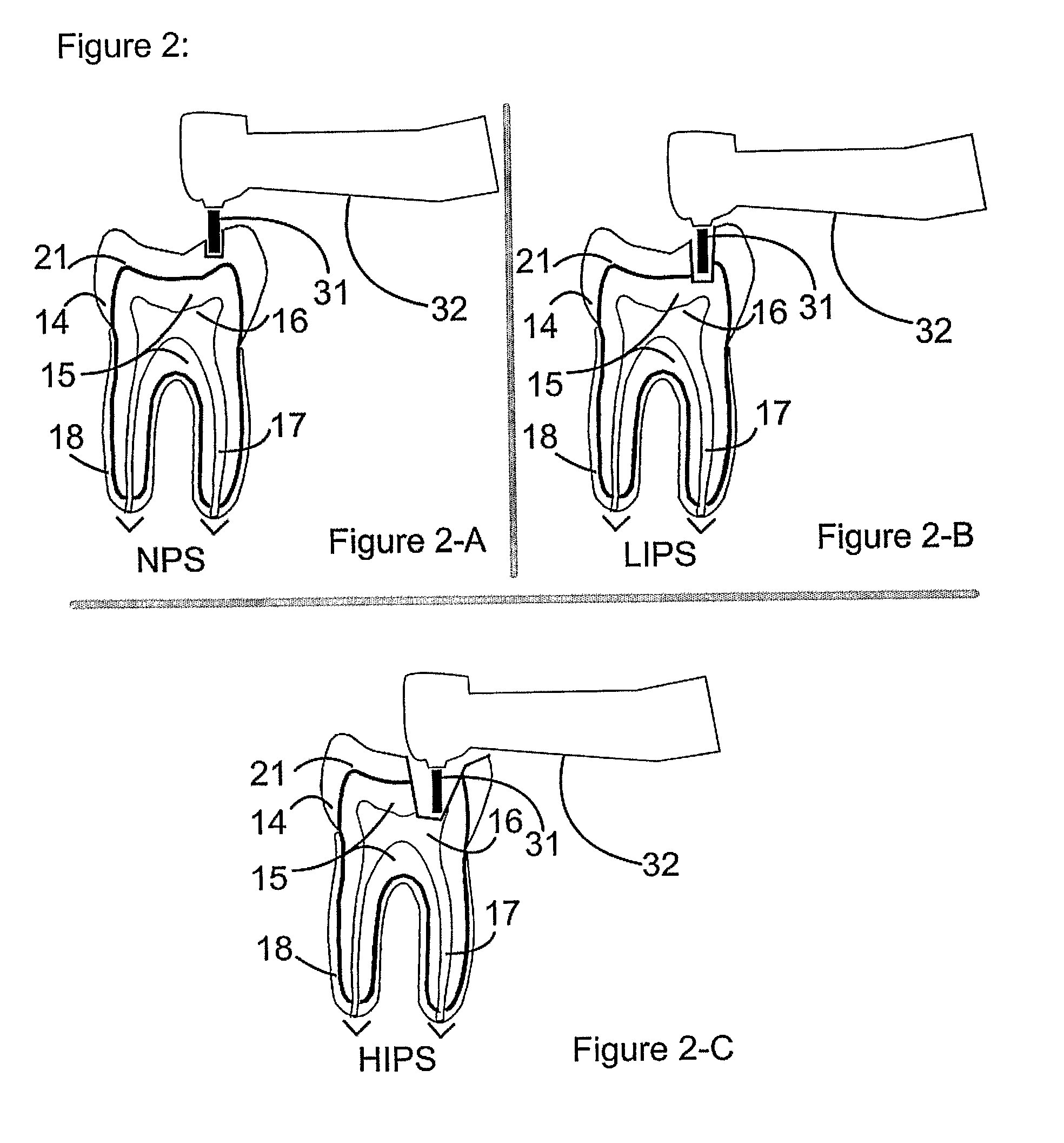 Method and a device for practicing dental treatments