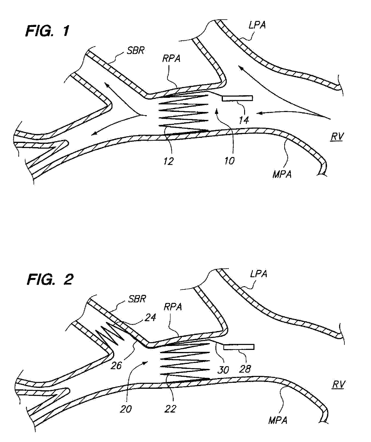 Devices for fixing a sensor in a lumen