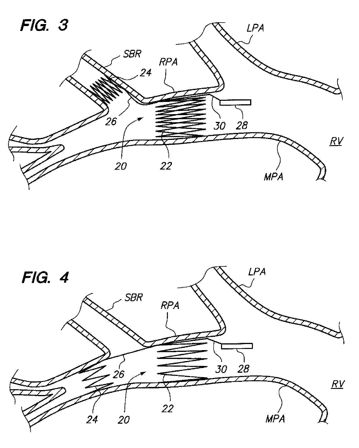 Devices for fixing a sensor in a lumen