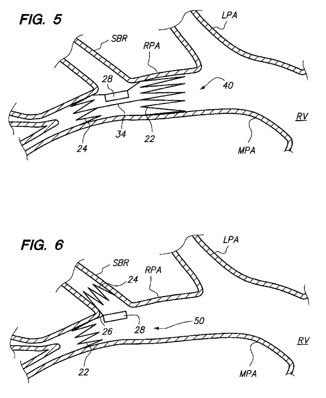 Devices for fixing a sensor in a lumen