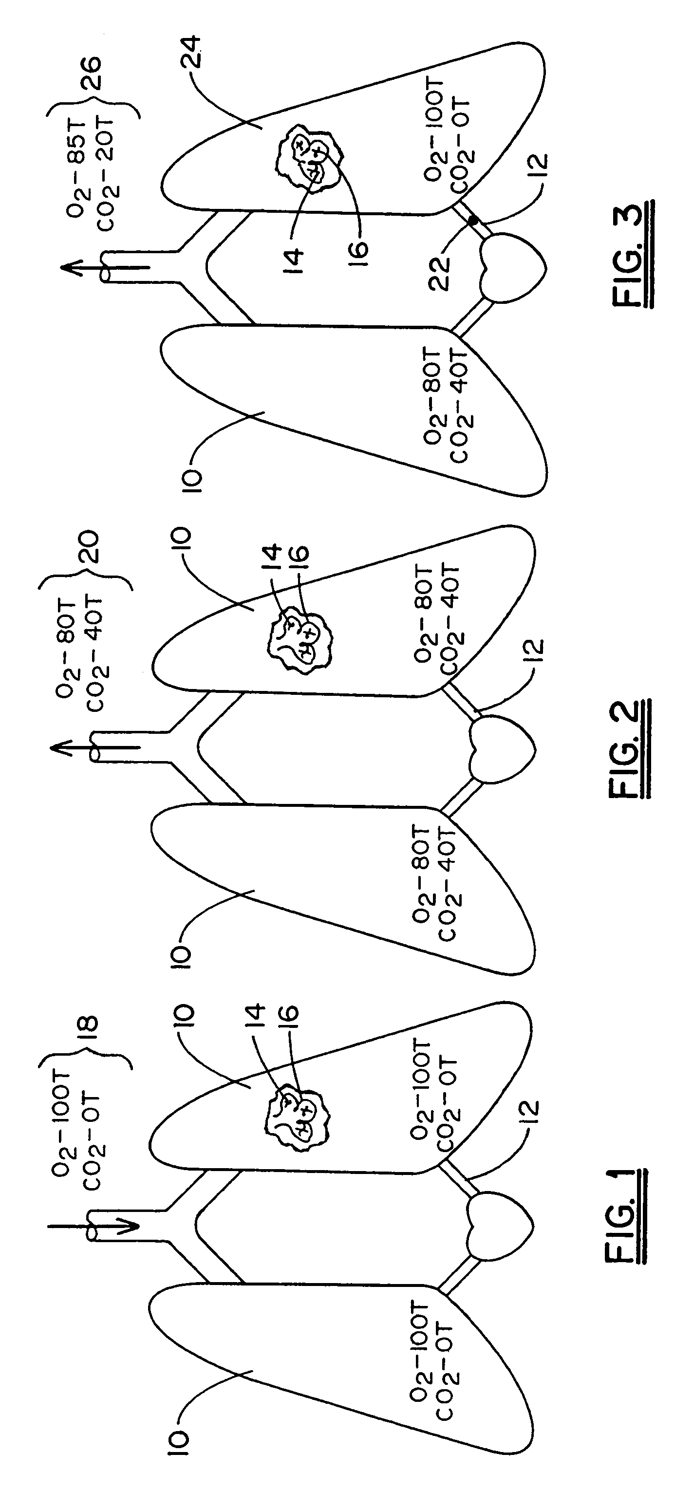 Non-invasive device and method for the diagnosis of pulmonary vascular occlusions