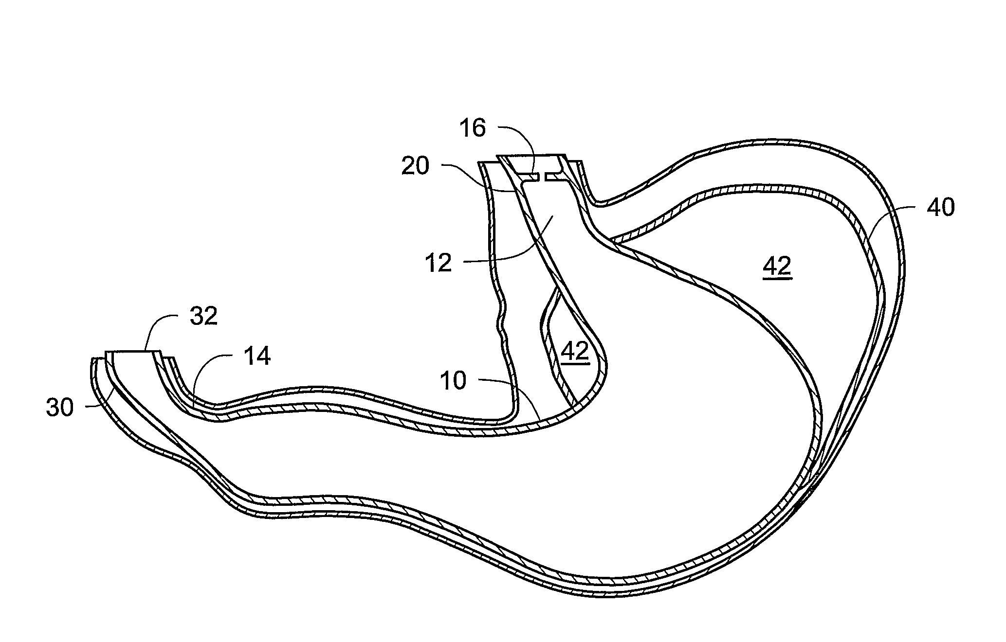 Gastric Bypass Devices and Methods