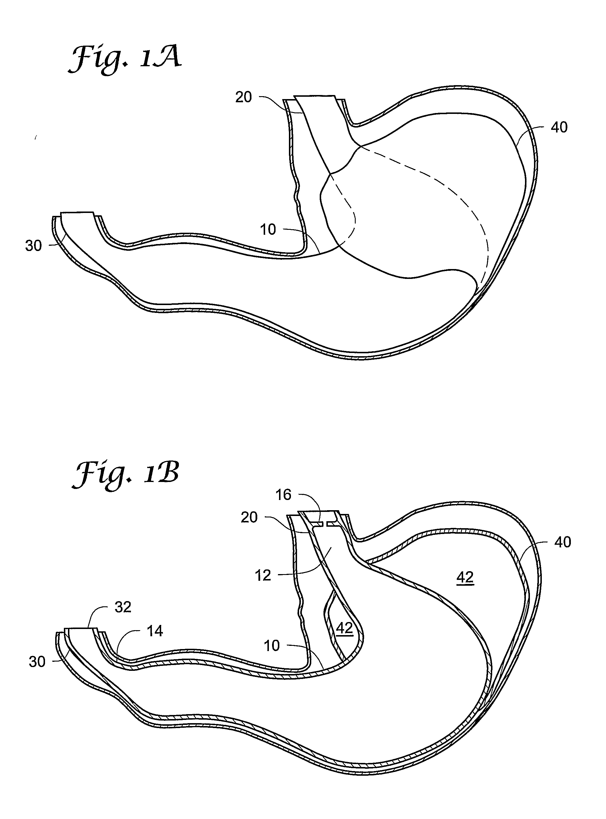 Gastric Bypass Devices and Methods