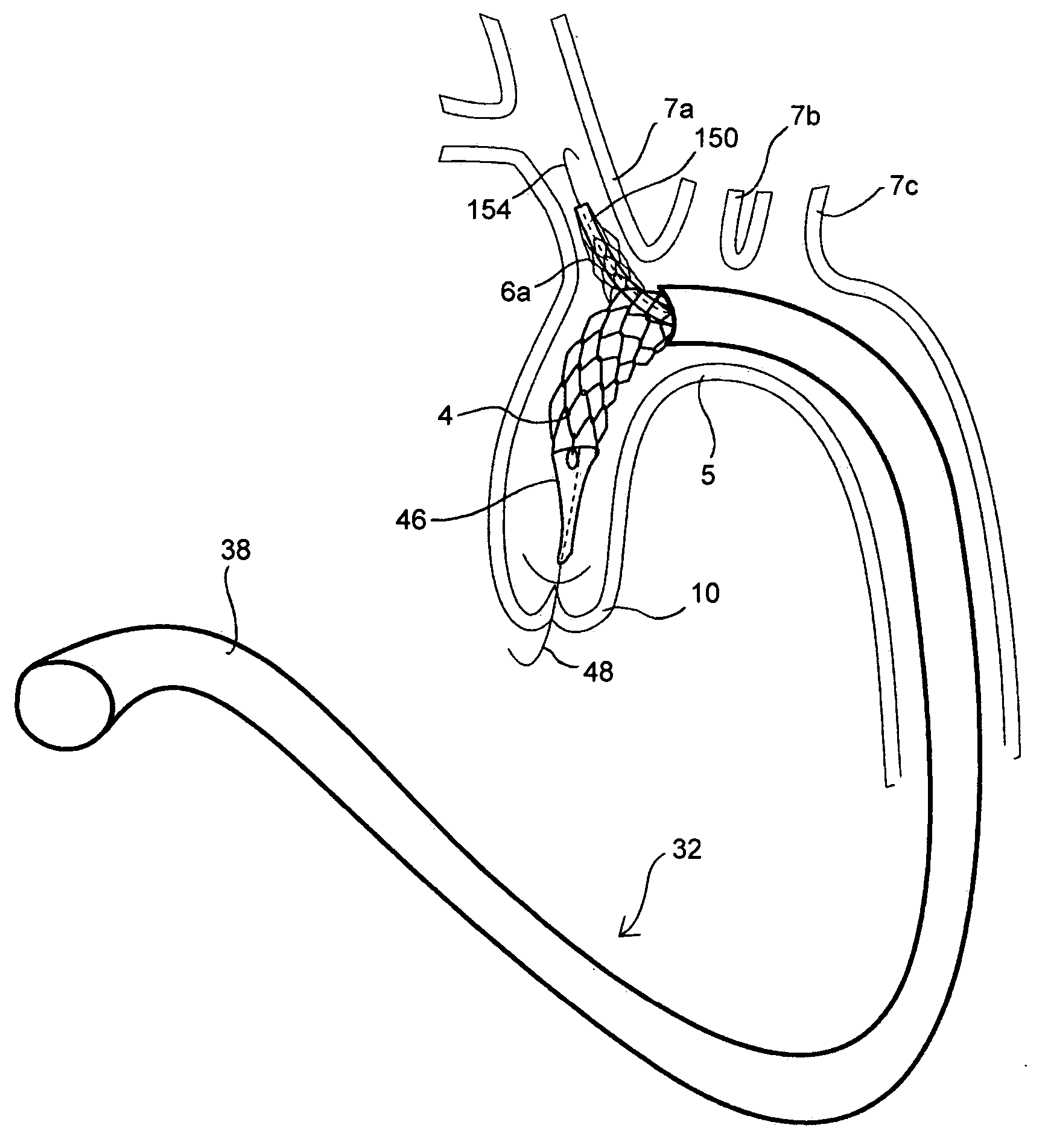 Methods for placing a stent in a branched vessel