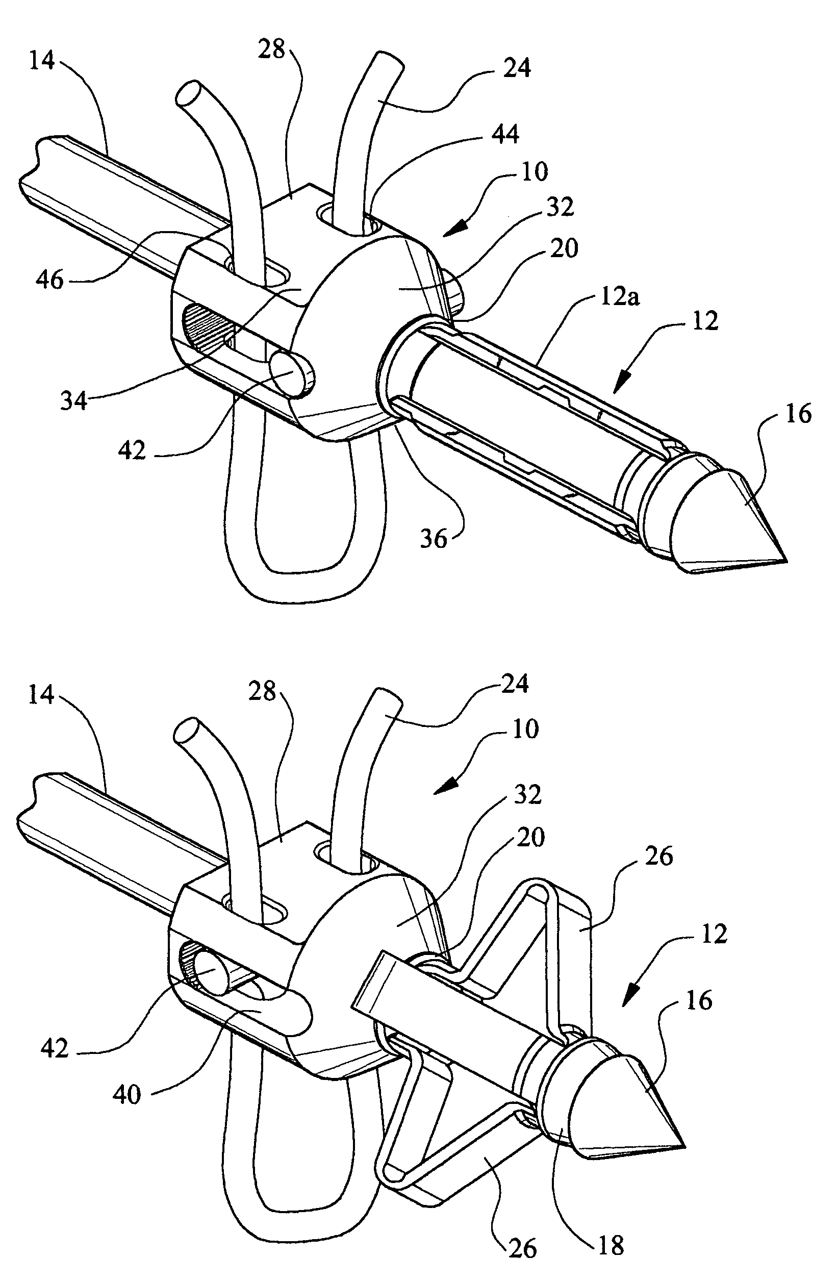 Anchor/suture used for medical procedures