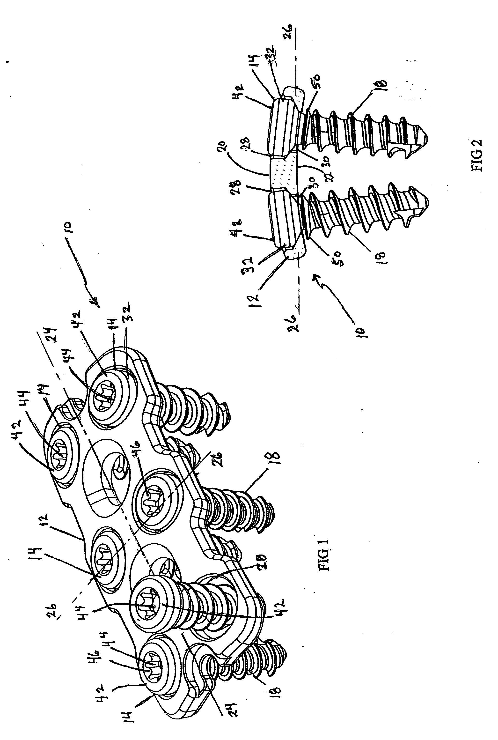 Anterior vertebral plate with closed thread screw