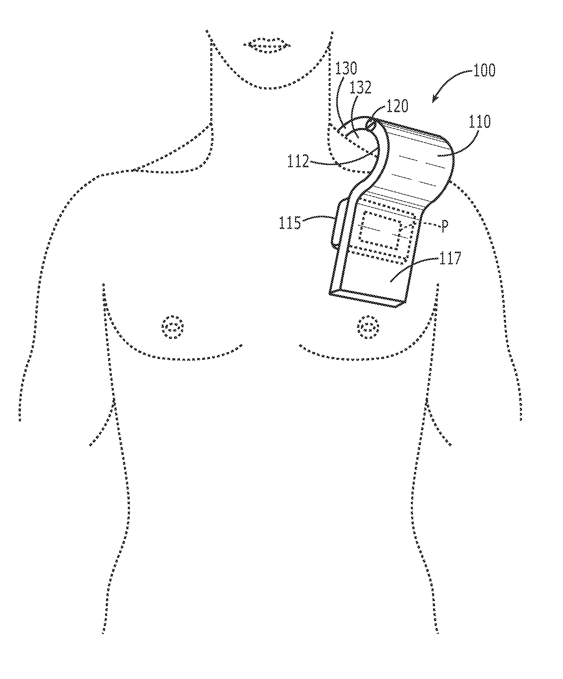 Device for applying pressure to a pocket to prevent hematoma after surgical implantation of medical device and method of using the same