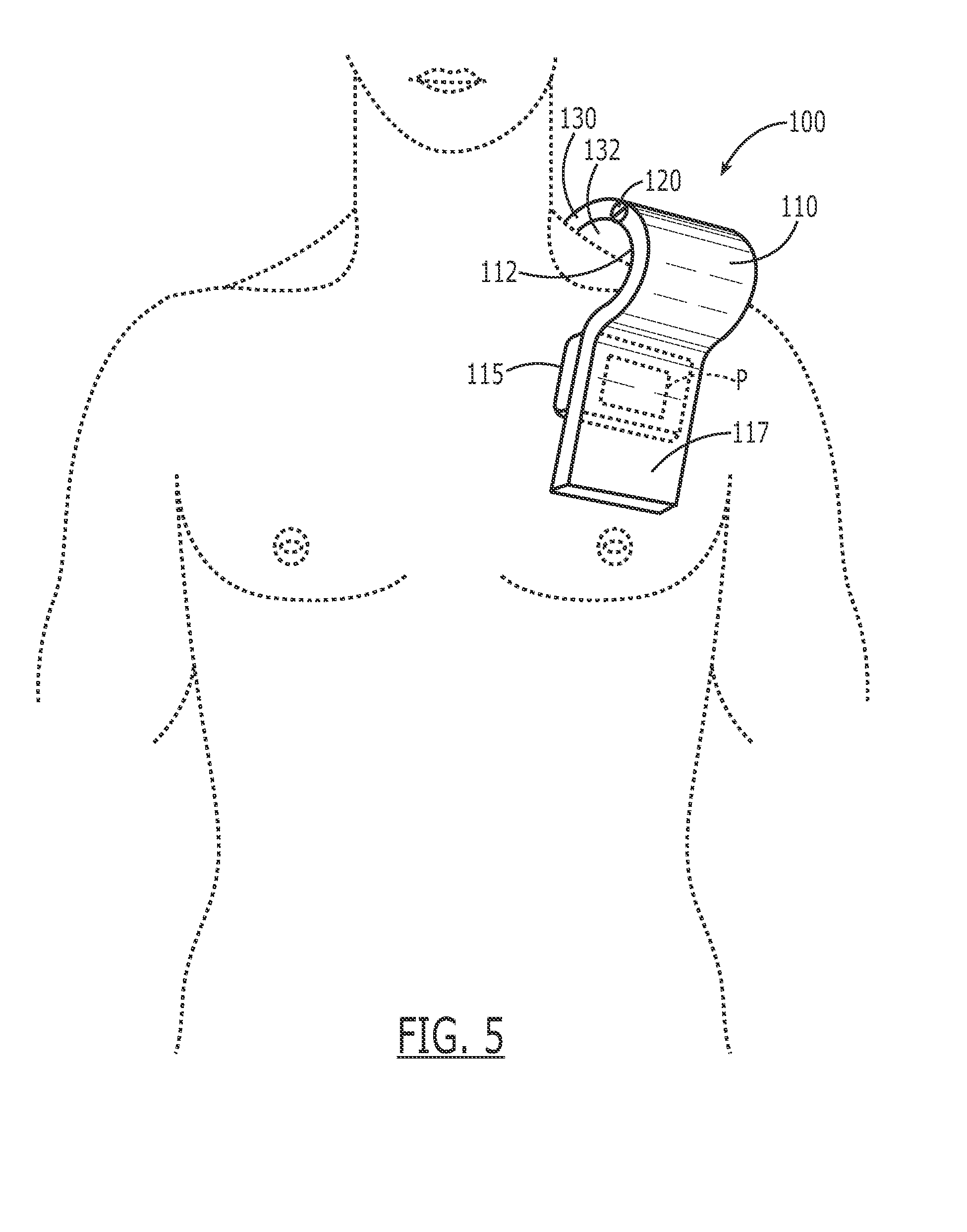 Device for applying pressure to a pocket to prevent hematoma after surgical implantation of medical device and method of using the same