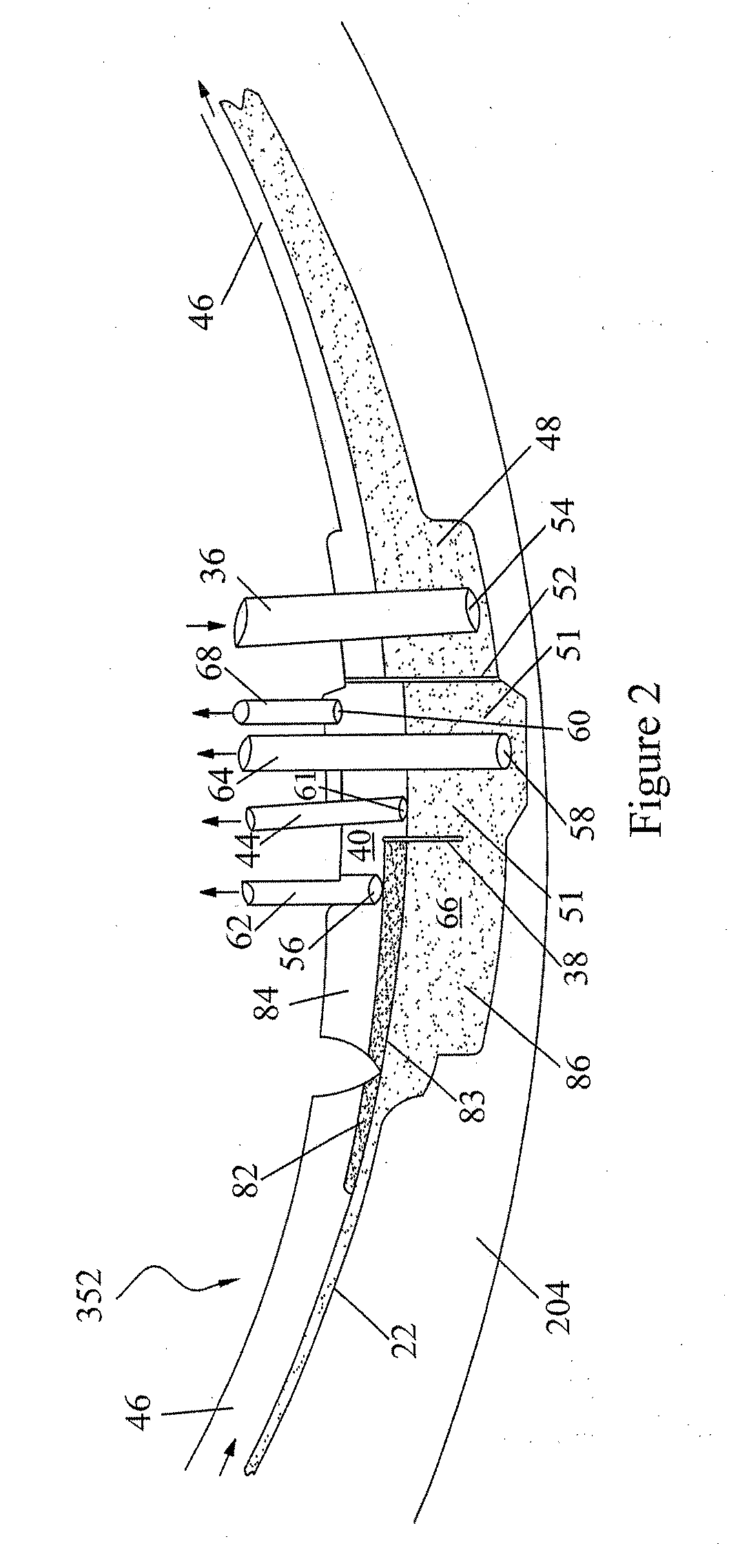Method and Apparatus for Leukoreduction of Red Blood Cells