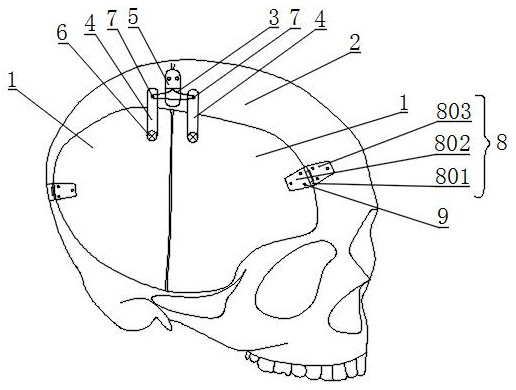 Anti-sinking device, skull decompressive craniectomy device and using method of skull decompressive craniectomy device