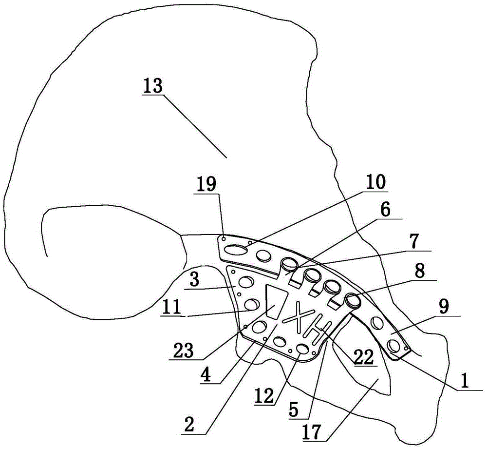 Acetabula pre/posterior column fracture fixing device and method