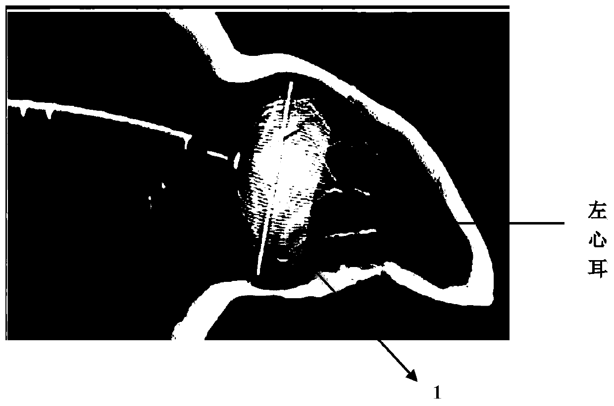 A repeatable retractable left atrial appendage occluder assembly and intervention method thereof