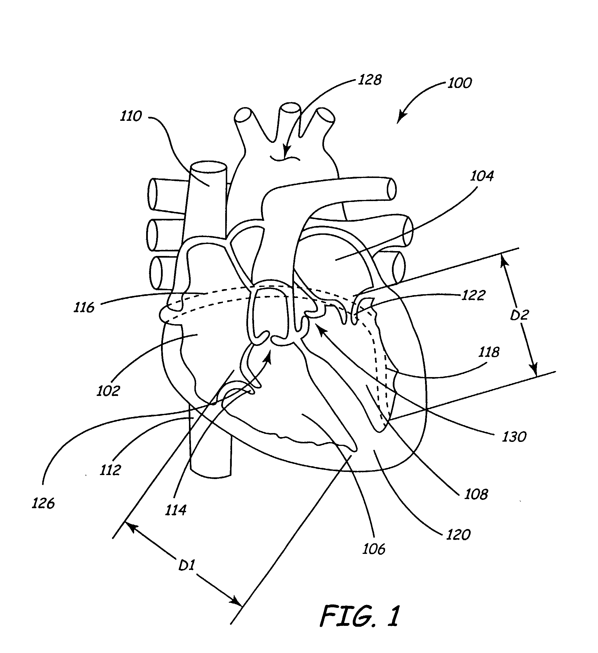 Apparatus and method for sensing spatial displacement in a heart